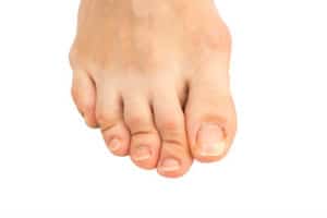 The causes of hammertoes (bent toes)