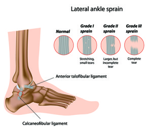 Grades of Ankle Sprains