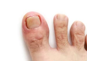 What to Do About an Ingrown Toenail