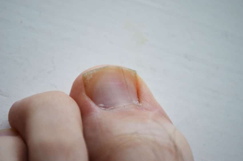 The Truth About Annoying Ingrown Toenails