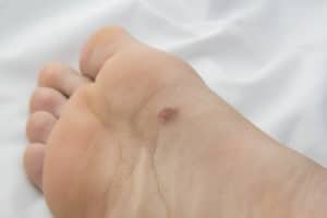 mole on bottom of foot