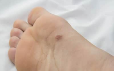 What Are Skin Cancers of the Feet?