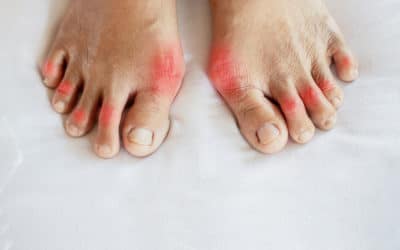 Our 6 Top Tips for Preventing Bunions